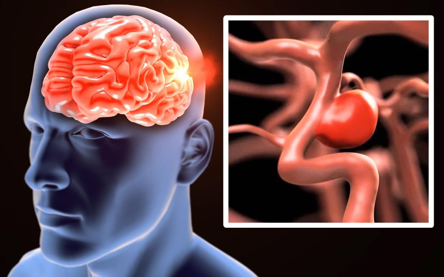 En este momento estás viendo ANEURISMA CEREBRAL, Causas, Síntomas, Complicaciones, PREVENIR ROTURA DE ANEURISMA, DERRAME CEREBRAL