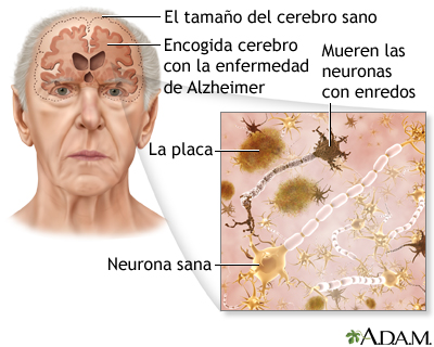 En este momento estás viendo TODO SOBRE ALZHEIMER (PARTE 1) CAUSAS, SÍNTOMAS, PREVENCIÓN? 👩‍⚕️❤️️